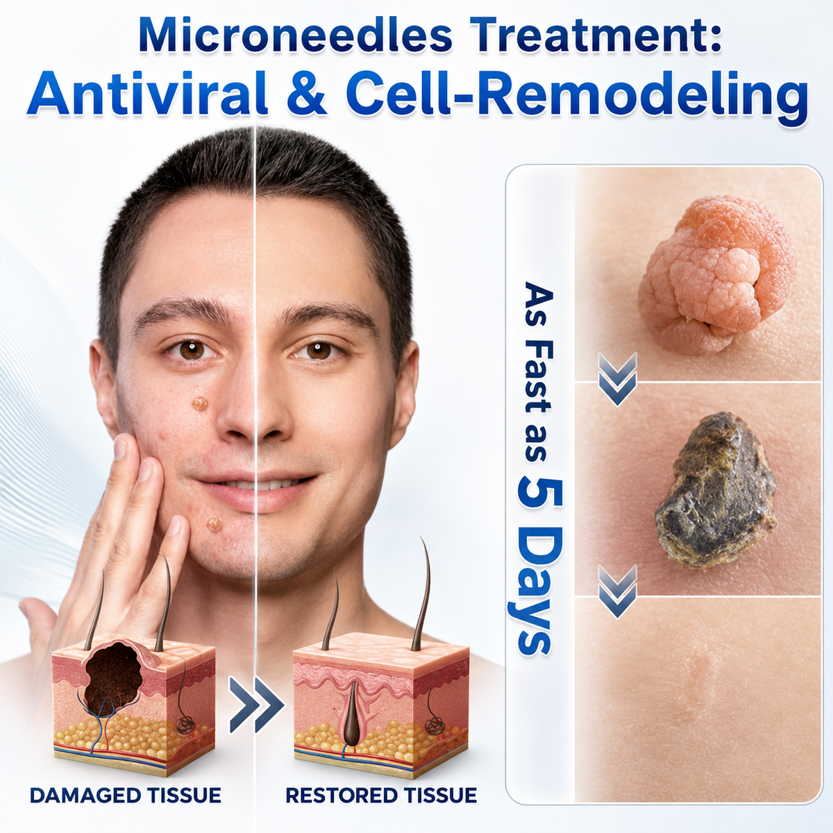 👩‍⚕️💎 𝐎𝐟𝐟𝐢𝐜𝐢𝐚𝐥 𝐒𝐭𝐨𝐫𝐞 | 𝑵𝐞𝒌𝐢𝐬𝐬® 🌿 𝐁𝐨𝐭𝐚𝐧𝐢𝐜𝐚𝐥 𝐌𝐢𝐜𝐫𝐨𝐧𝐞𝐞𝐝𝐥𝐞 𝐇𝐲𝐝𝐫𝐨𝐜𝐨𝐥𝐥𝐨𝐢𝐝 𝐏𝐚𝐭𝐜𝐡 (𝐅𝐨𝐫 𝐒𝐤𝐢𝐧 𝐓𝐚𝐠𝐬, 𝐒𝐦𝐚𝐥𝐥 𝐒𝐤𝐢𝐧 𝐆𝐫𝐨𝐰𝐭𝐡𝐬, 𝐖𝐚𝐫𝐭𝐬, 𝐌𝐨𝐥𝐞𝐬, 𝐀𝐠𝐞 𝐒𝐩𝐨𝐭𝐬 & 𝐏𝐢𝐠𝐦𝐞𝐧𝐭𝐚𝐭𝐢𝐨𝐧 𝐂𝐨𝐧𝐜𝐞𝐫𝐧𝐬)